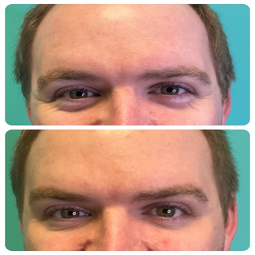Botox for crows feet reduction London ON