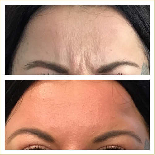 Botox-for-frown-line-Glabellar-by-Pureglo
