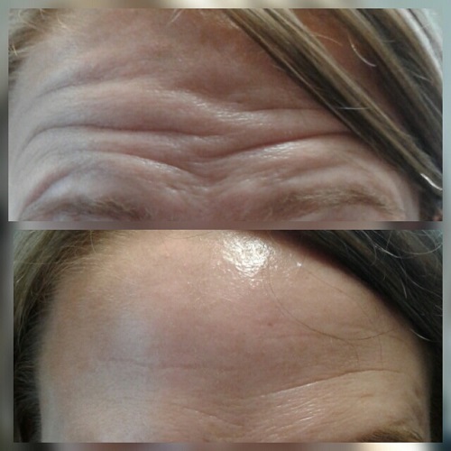 Botox for frown line reduction