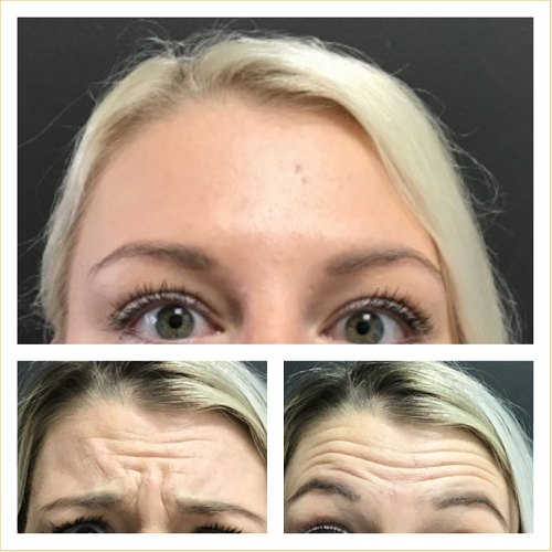 Botox-for-frown-line-reduction-2
