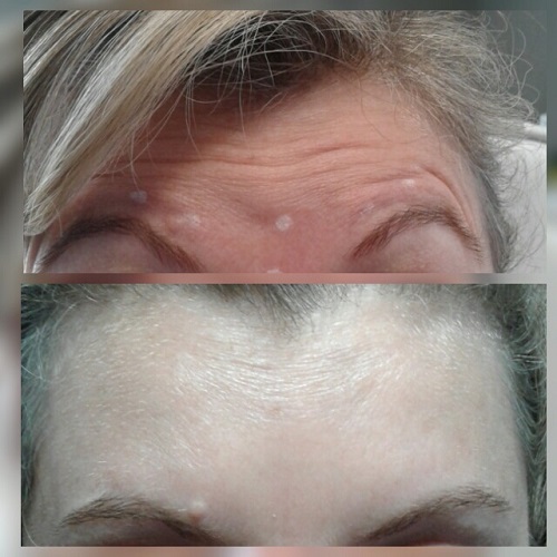 Botox for frown line reduction London Ontario