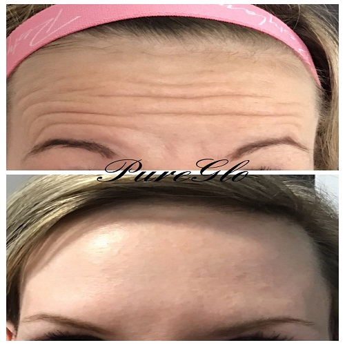 Botox for frown line reduction London Ontario 2