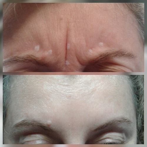 Botox for frown line reduction Pureglo