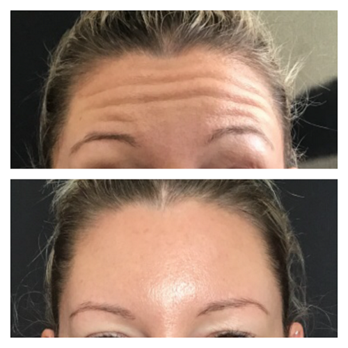 Botox for frown lines by Pureglo